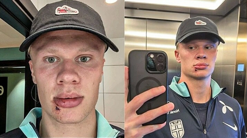 haaland-bi-cua-xe-bus-ha-guc-odegaard-la-thu-pham